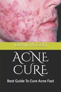 Acne Cure: Best Guide To Cure Acne Fast