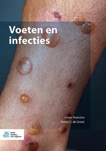 Voeten en infecties voorzijde