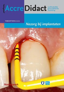 Nazorg bij implantaten voorzijde